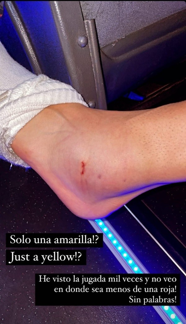 Así quedó el tobillo de Ronald Matarrita (Foto: Instagram de Ronald Matarrita)